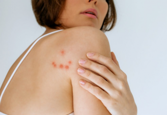 Come riconoscere e trattare le reazioni allergiche alle punture di cimici da letto