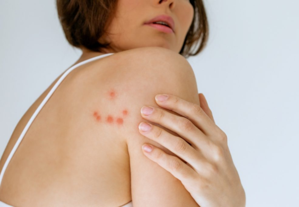 Come riconoscere e trattare le reazioni allergiche alle punture di cimici da letto